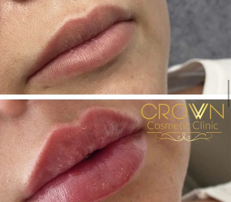 Russian Lip Filler - Crown Cosmetic Clinic