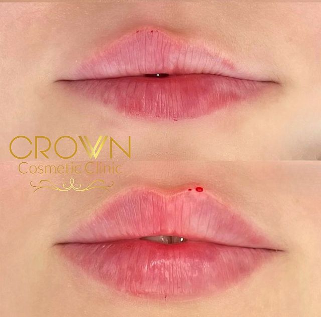 Russian Lip Filler - Crown Cosmetic Clinic